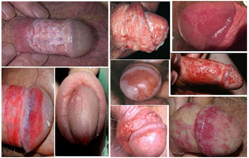 Điểm mặt những căn bệnh bộ phận sinh dục nam nguy hiểm 5